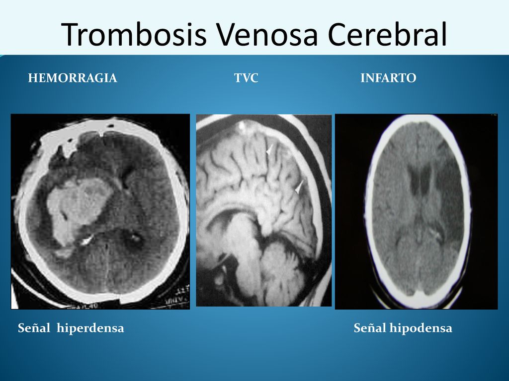 Hemorragia cerebral vs infarto